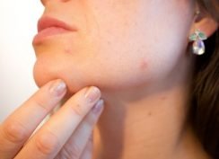 7 Signs That Acne is Healing