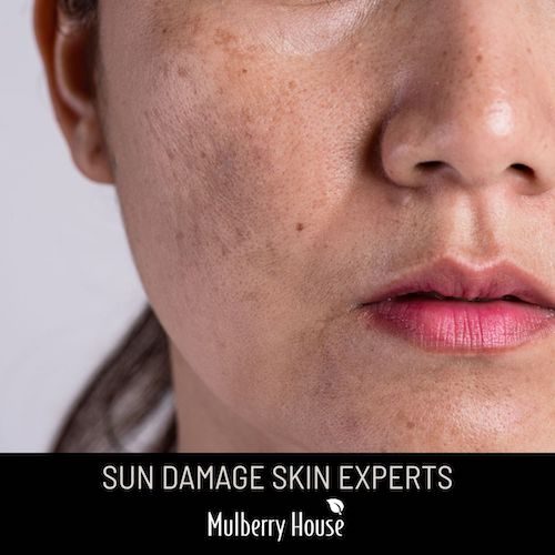 Melasma - Latest Advanced Treatment Options