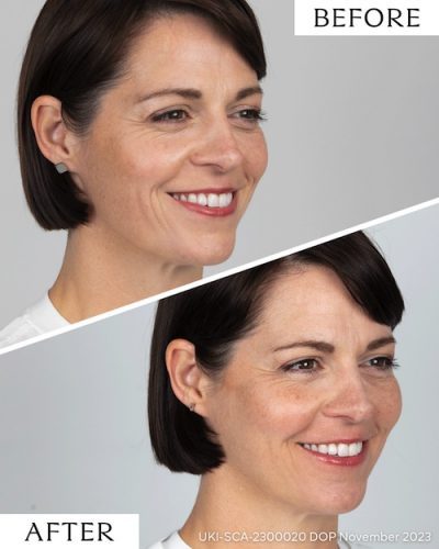 Sculptra Before & After Photos