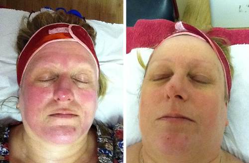 LED - Treatment for Rosacea that Works!