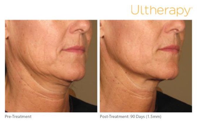 Redefine the Jawline with Ultherapy
