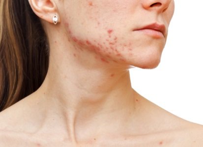 4 Stages of Acne